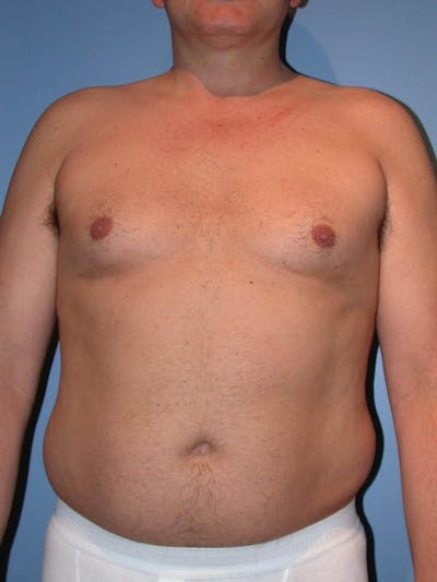 Male Liposuction Gallery Before & After Gallery - Patient 6097151 - Image 1