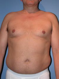 Male Liposuction Before & After Gallery - Patient 6097151 - Image 1