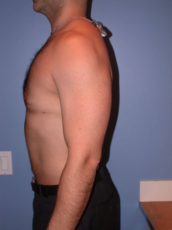 Male Liposuction Gallery - Patient 6097150 - Image 4