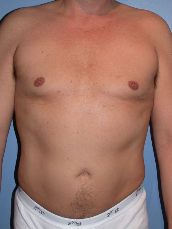 Male Liposuction Before & After Gallery - Patient 6097151 - Image 2