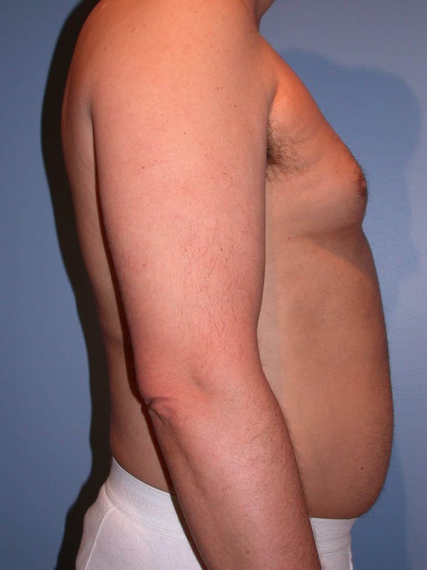 Male Liposuction Gallery Before & After Gallery - Patient 6097151 - Image 3