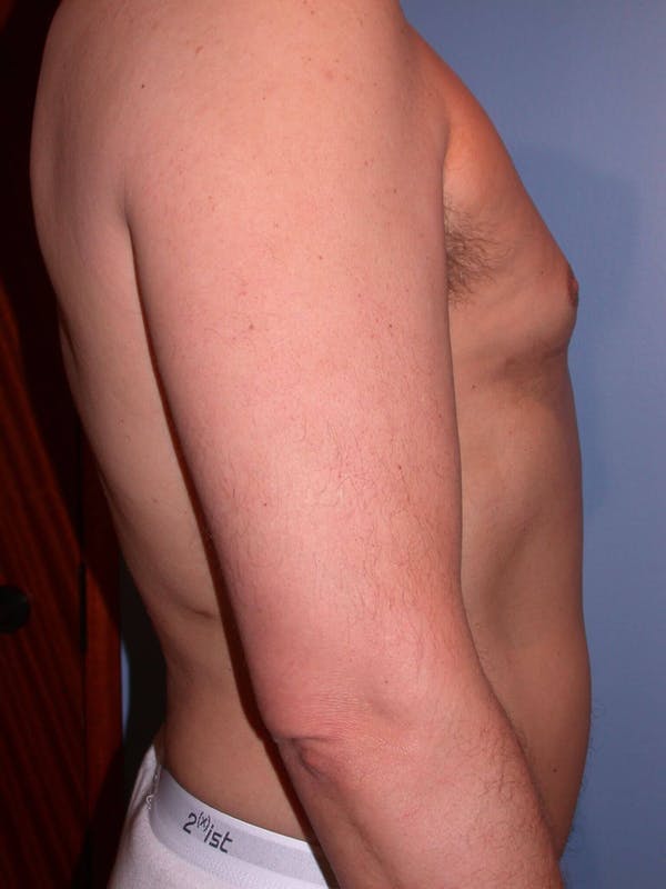 Male Liposuction Gallery Before & After Gallery - Patient 6097151 - Image 4