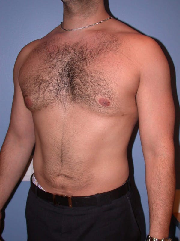 Male Liposuction Gallery - Patient 6097150 - Image 8