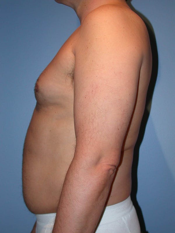 Male Liposuction Gallery Before & After Gallery - Patient 6097151 - Image 5