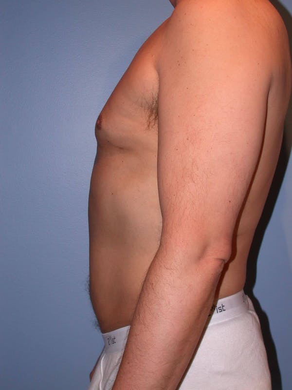 Male Liposuction Gallery Before & After Gallery - Patient 6097151 - Image 6
