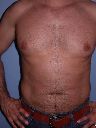 Male Liposuction Gallery Before & After Gallery - Patient 6097153 - Image 1