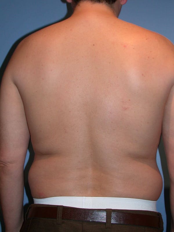 Male Liposuction Gallery Before & After Gallery - Patient 6097151 - Image 7