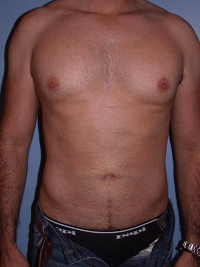 Male Liposuction Gallery Before & After Gallery - Patient 6097153 - Image 2
