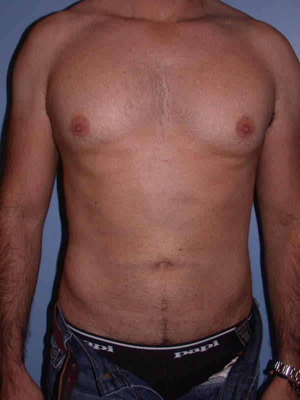 Male Liposuction Gallery - Patient 6097153 - Image 2