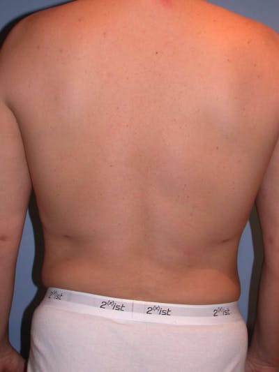 Male Liposuction Before & After Gallery - Patient 6097151 - Image 8