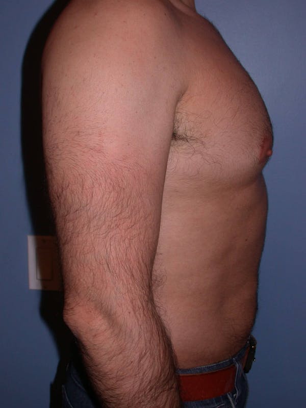 Male Liposuction Gallery Before & After Gallery - Patient 6097153 - Image 3