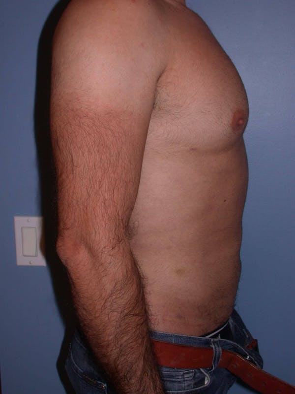 Male Liposuction Gallery Before & After Gallery - Patient 6097153 - Image 4