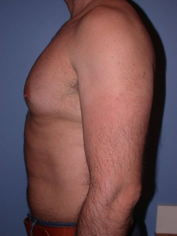 Male Liposuction Before & After Gallery - Patient 6097153 - Image 5