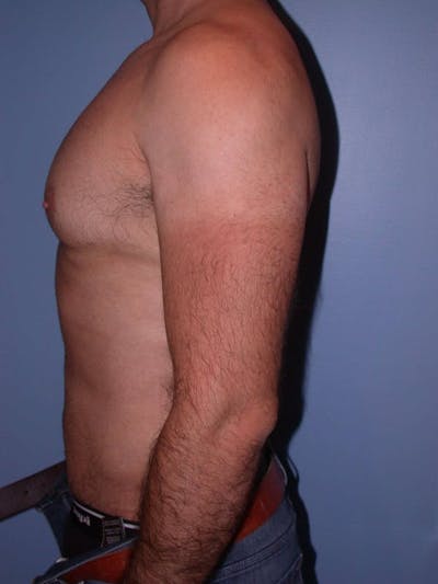 Male Liposuction Gallery Before & After Gallery - Patient 6097153 - Image 6