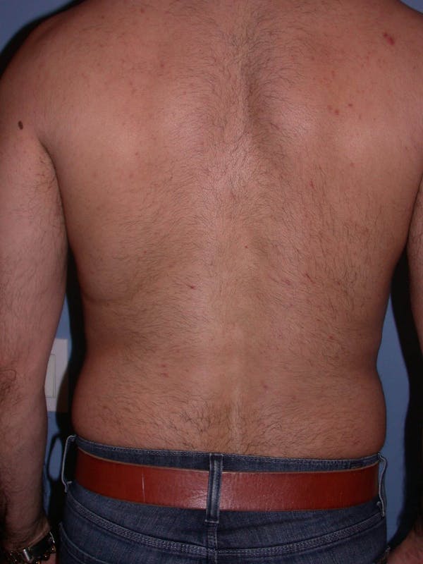 Male Liposuction Gallery Before & After Gallery - Patient 6097153 - Image 7