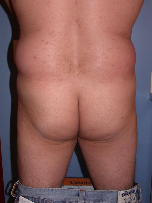 Male Brazilian Butt Lift Gallery Before & After Gallery - Patient 6097230 - Image 1