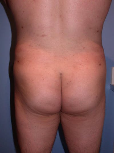 Male Brazilian Butt Lift Before & After Gallery - Patient 6097230 - Image 2