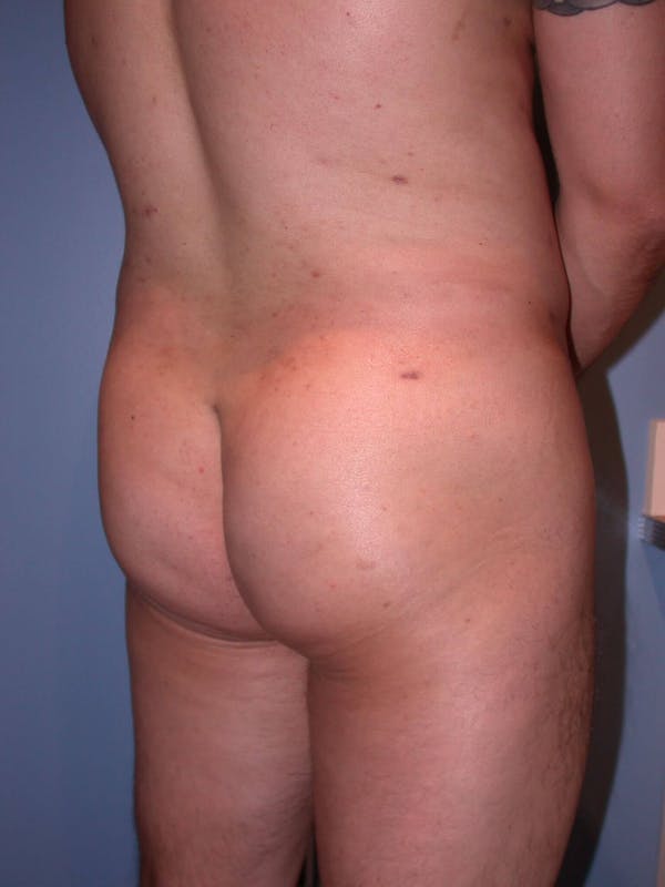 Male Brazilian Butt Lift Gallery Before & After Gallery - Patient 6097230 - Image 4
