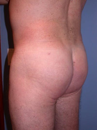 Male Brazilian Butt Lift Gallery Before & After Gallery - Patient 6097231 - Image 2