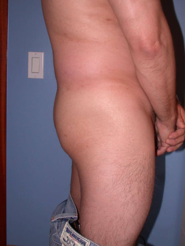 Male Brazilian Butt Lift Before & After Gallery - Patient 6097230 - Image 5