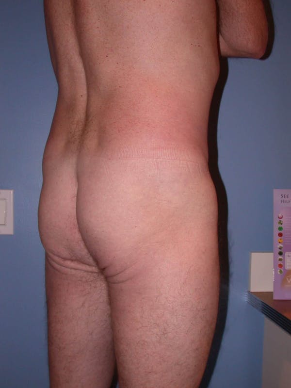 Male Brazilian Butt Lift Gallery Before & After Gallery - Patient 6097231 - Image 3