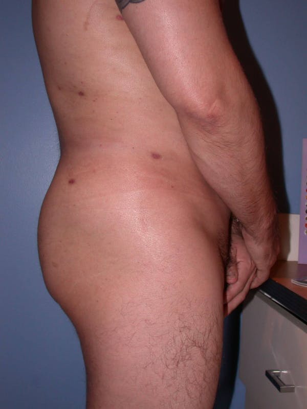Male Brazilian Butt Lift Gallery Before & After Gallery - Patient 6097230 - Image 6