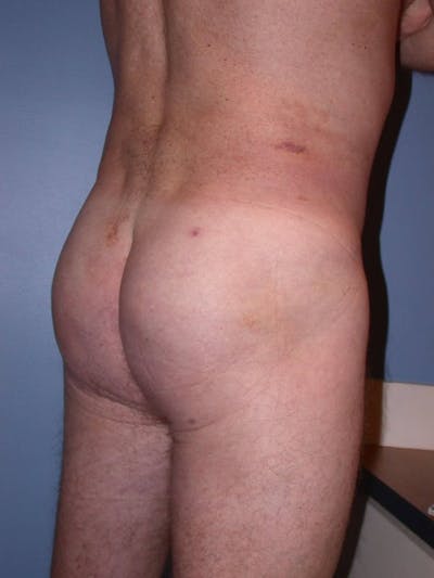 Male Brazilian Butt Lift Gallery Before & After Gallery - Patient 6097231 - Image 4