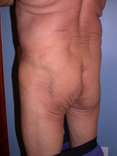 Male Brazilian Butt Lift Gallery Before & After Gallery - Patient 6097232 - Image 1