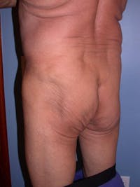Male Brazilian Butt Lift Before & After Gallery - Patient 6097232 - Image 1