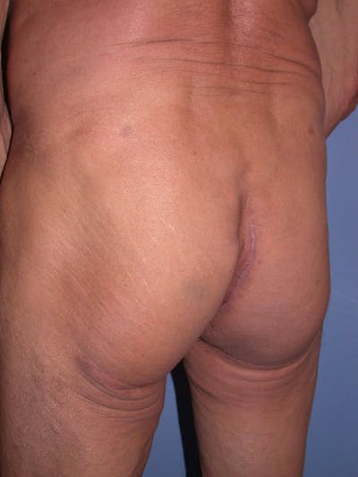 Male Brazilian Butt Lift Gallery Before & After Gallery - Patient 6097232 - Image 2