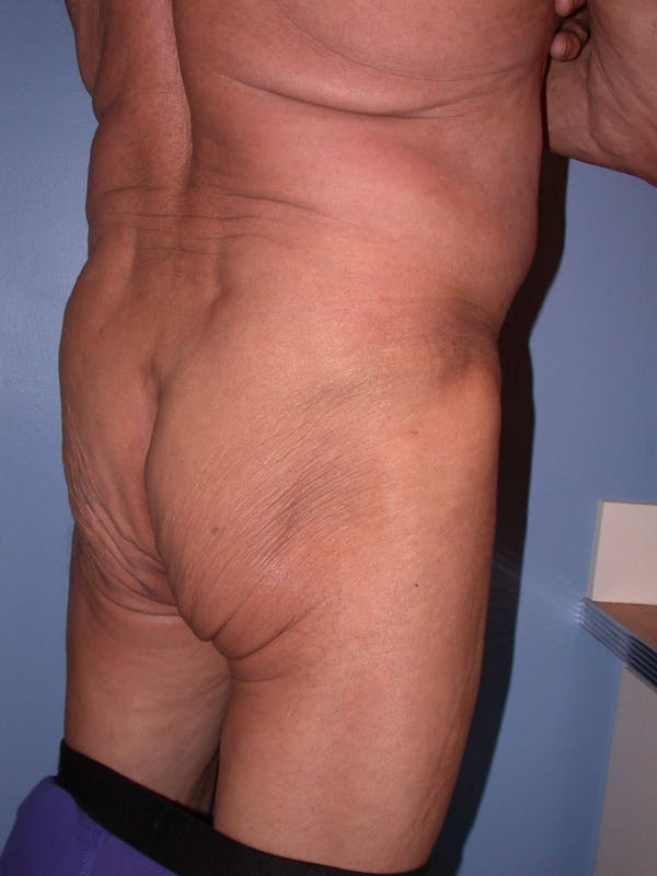 Male Brazilian Butt Lift Gallery Before & After Gallery - Patient 6097232 - Image 3