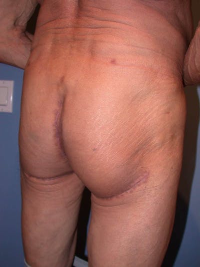 Male Brazilian Butt Lift Gallery Before & After Gallery - Patient 6097232 - Image 4