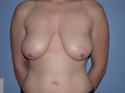 Breast Lift Gallery Before & After Gallery - Patient 6406949 - Image 1