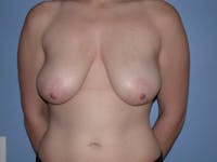 Breast Lift Before & After Gallery - Patient 6406949 - Image 1