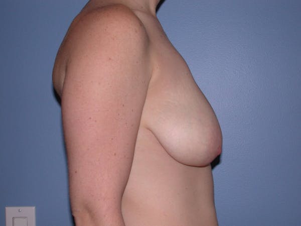 Breast Lift Gallery Before & After Gallery - Patient 6406949 - Image 3