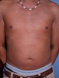 High Definition Liposuction Gallery - Patient 6407017 - Image 1