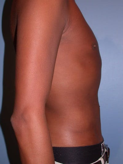 High Definition Liposuction Gallery Before & After Gallery - Patient 6407017 - Image 6