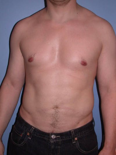 High Definition Liposuction Before & After Gallery - Patient 6407019 - Image 2