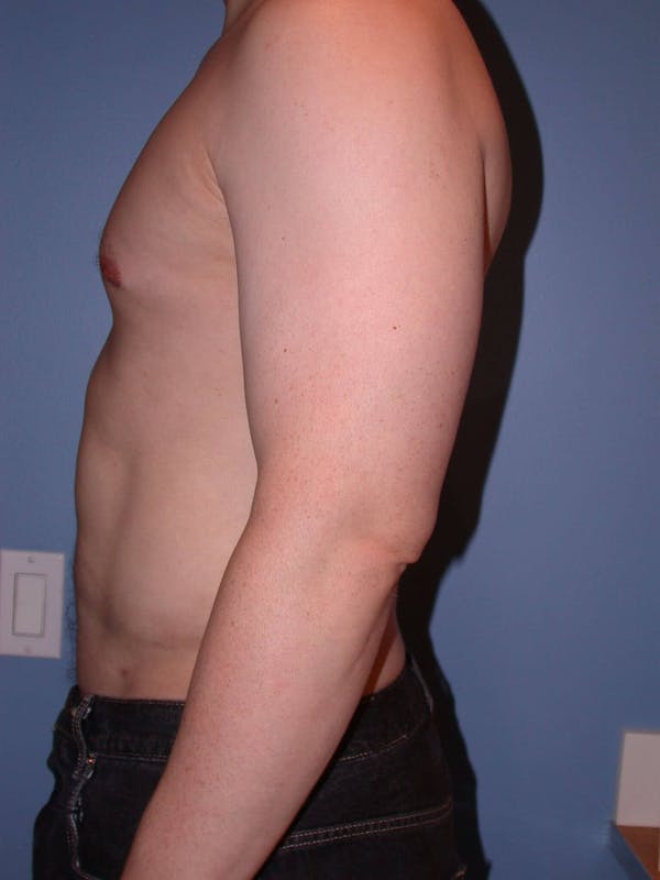 High Definition Liposuction Before & After Gallery - Patient 6407019 - Image 4