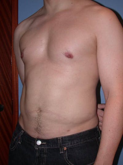High Definition Liposuction Before & After Gallery - Patient 6407019 - Image 8