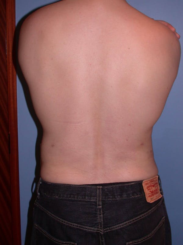 High Definition Liposuction Gallery Before & After Gallery - Patient 6407019 - Image 10
