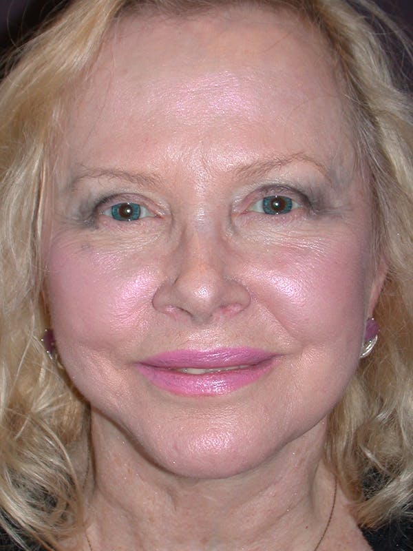 Facelift Gallery Before & After Gallery - Patient 7316658 - Image 1