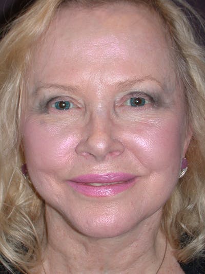 Facelift Before & After Gallery - Patient 7316658 - Image 1
