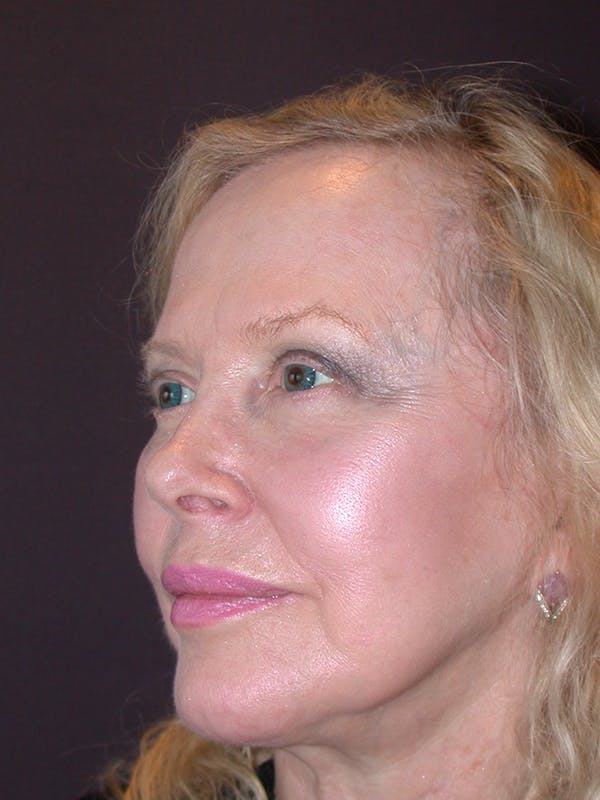 Facelift Gallery Before & After Gallery - Patient 7316658 - Image 3