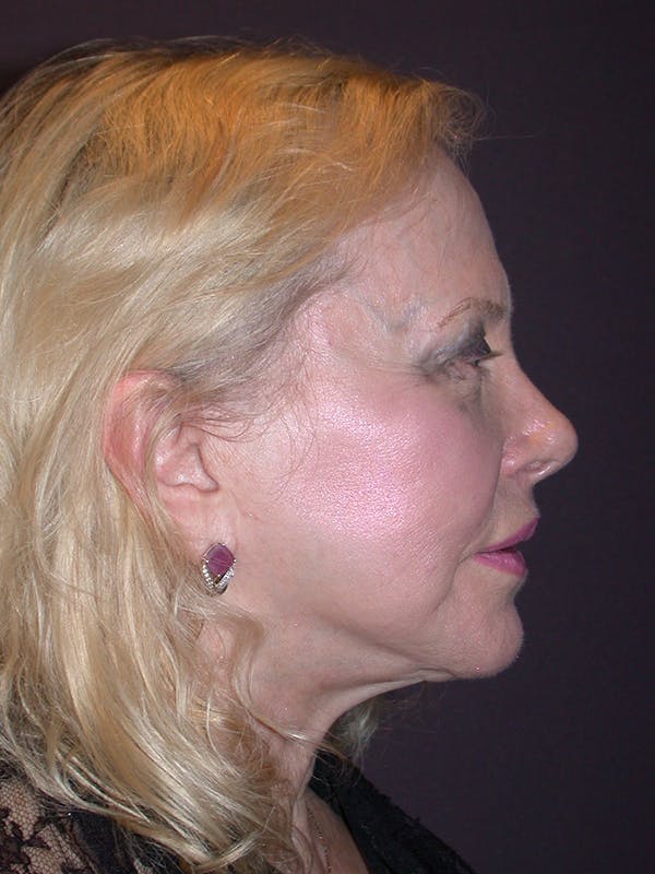 Facelift Gallery Before & After Gallery - Patient 7316658 - Image 5