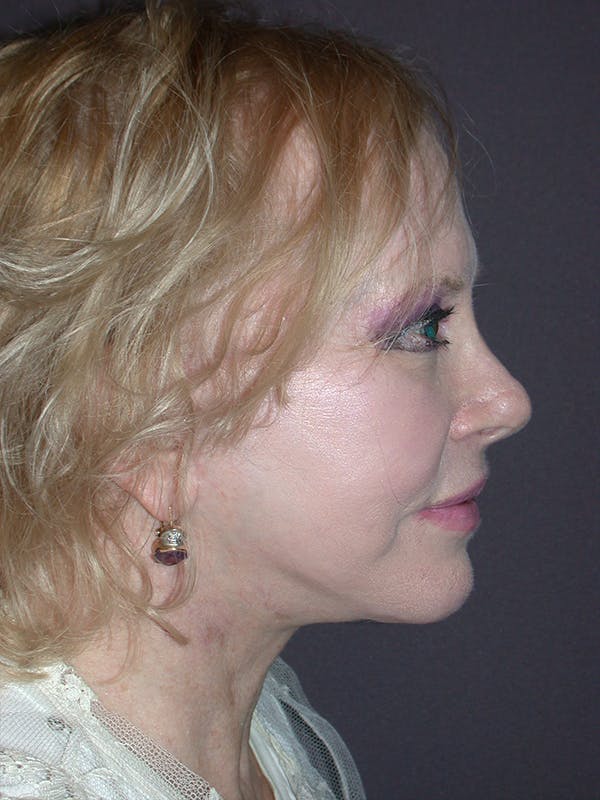Facelift Gallery Before & After Gallery - Patient 7316658 - Image 6