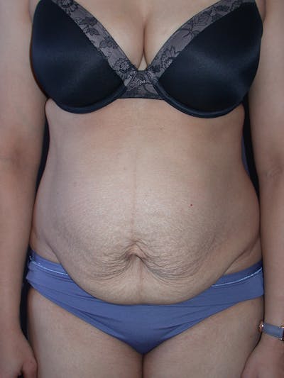 Tummy Tuck Gallery Before & After Gallery - Patient 7316694 - Image 1