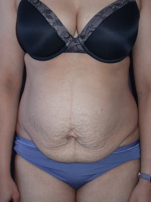 Before & After a Tummy Tuck in San Francisco