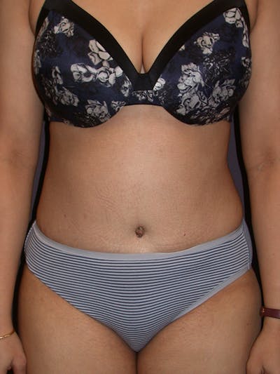 Tummy Tuck Gallery Before & After Gallery - Patient 7316694 - Image 2