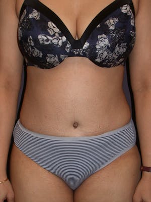 Before & After a Tummy Tuck in San Francisco